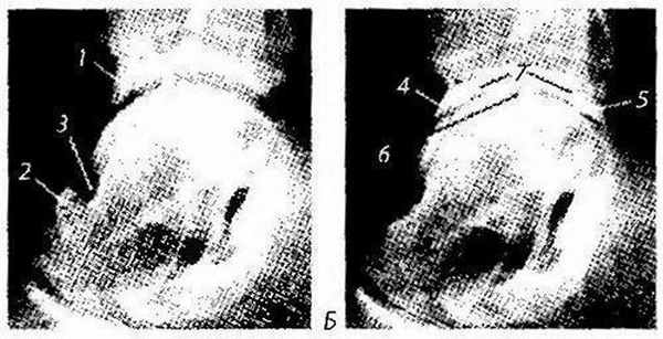 Рентгенограмма голеностопного сустава с признаками таранно-большеберцового экзостоза и артроза