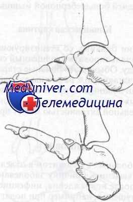 таранно-большеберцовый экзостоз