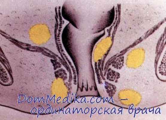 Локализации парапроктита