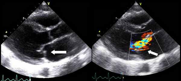митральная регургитация