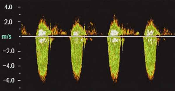 стеноз аортального клапана