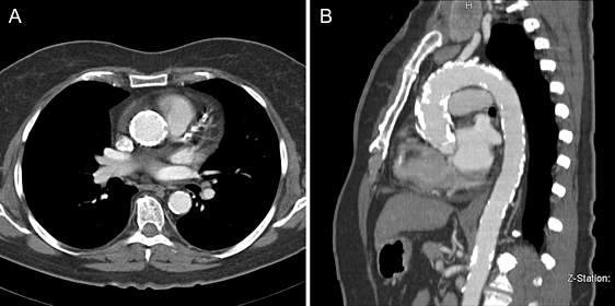 Фарфоровая аорта