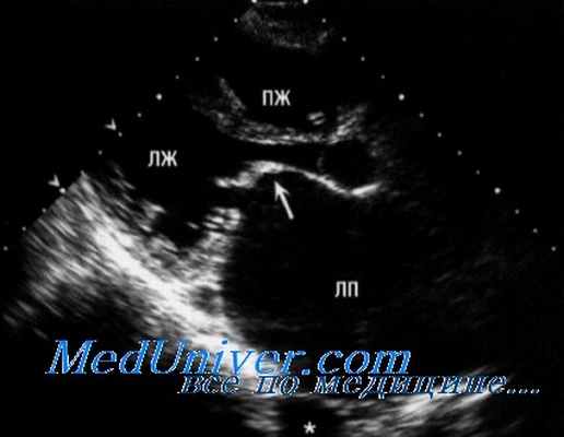 аортальный стеноз