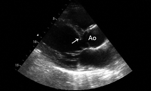 Дискретный субаортальный стеноз - врожденная аномалия выносящего тракта левого желудочка