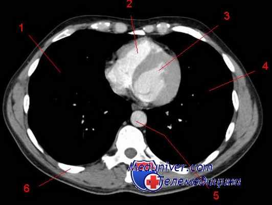 лимфосаркома средостения