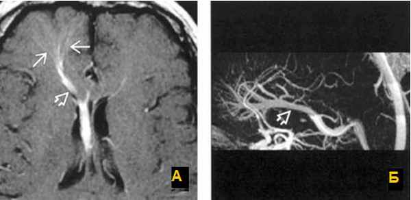  Применение МРТ в исследовании вен головного мозга