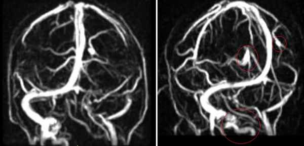  Применение МРТ в исследовании вен головного мозга