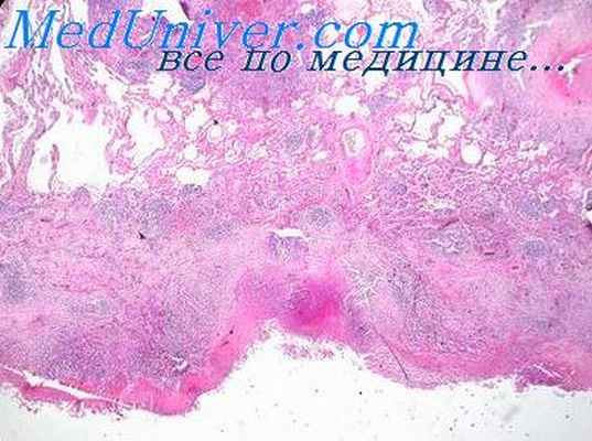 туберкулез лимфатических узлов