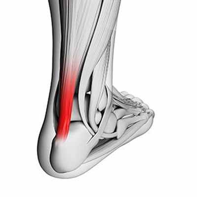 Почему болит ахилл после бега