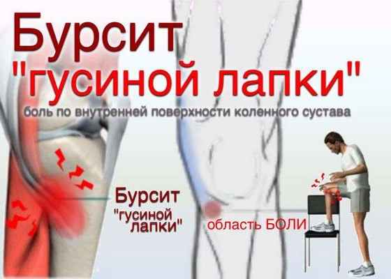 Анзериновый бурсит