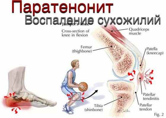 Паратенонит (воспаление сухожилий)