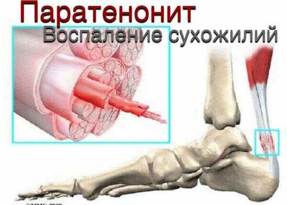 Паратенонит (воспаление сухожилий)