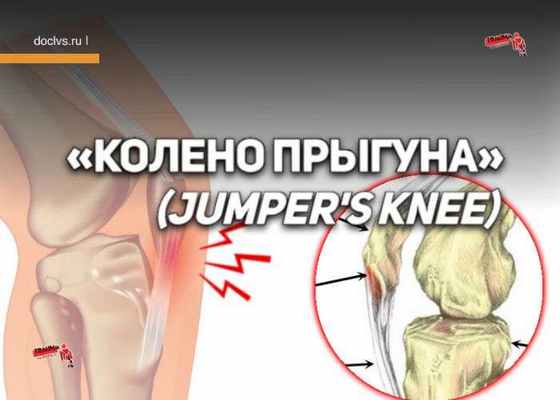 «Колено прыгуна»