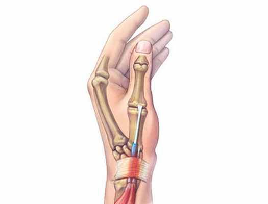 Теносиновит Де Кервена