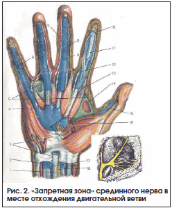 Рис. 2. «Запретная зона» срединного нерва в месте отхождения двигательной ветви