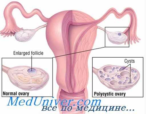 поликистозные яичники