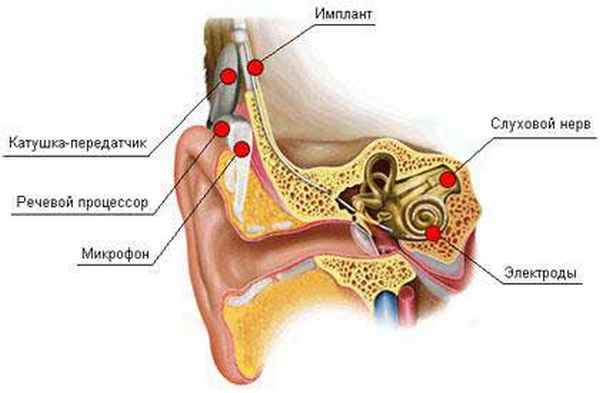 Отосклероз
