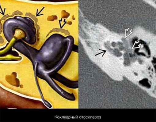 Отосклероз