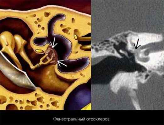 Отосклероз