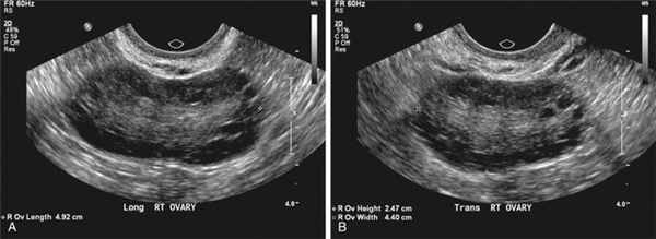 поликистоз яичников (спкя) на УЗИ