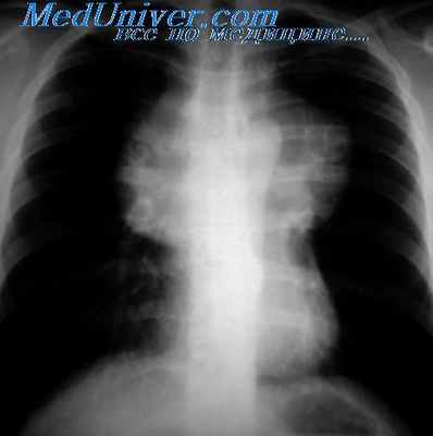 тератомы средостения