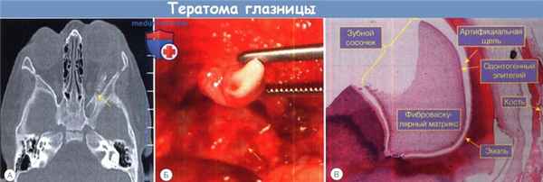 Тератома глазницы