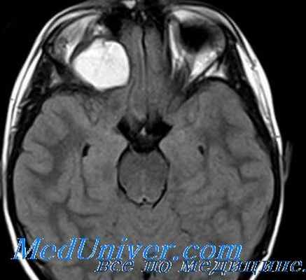 фиброма глаза