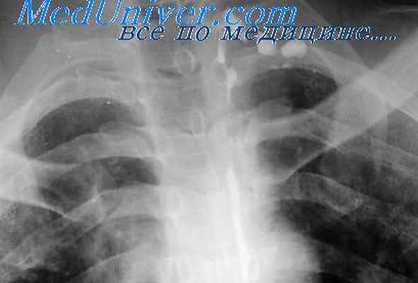 бронхоспирометрия