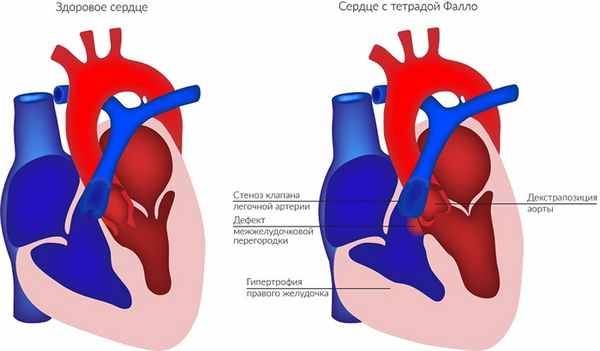 Fallot_tetralogy.jpg