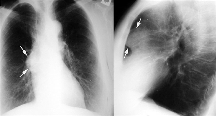 Тимома при рентгенографии