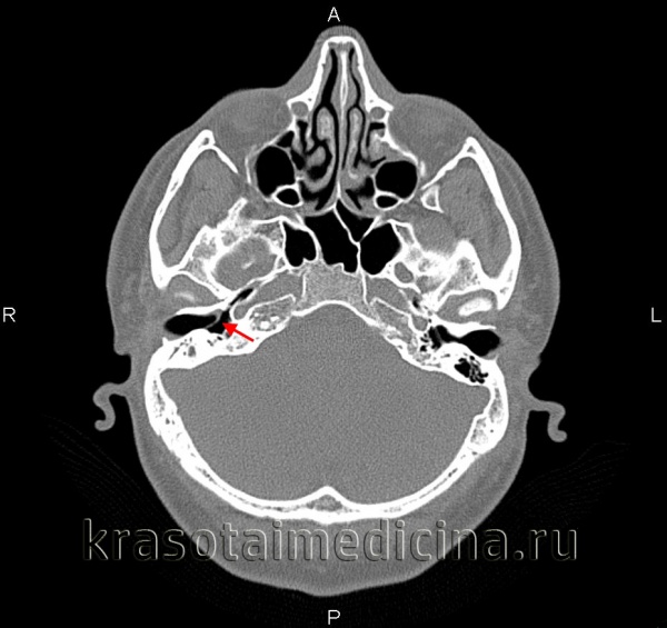 Тимпаносклероз