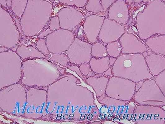 тиреодити риделя