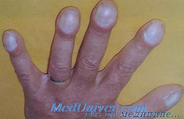 Барабанные пальцы