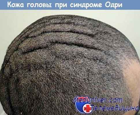 Складчатая пахидермия - синдром Одри