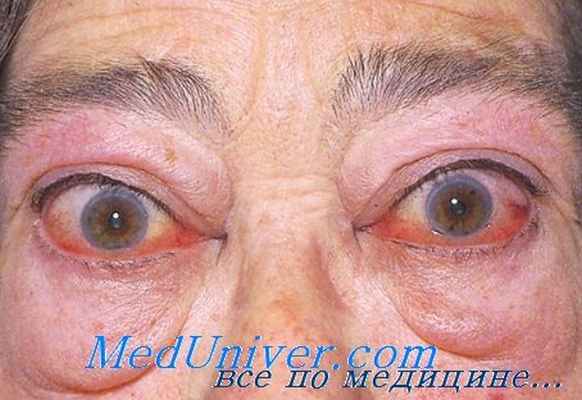 тиреотоксический экзофтальм