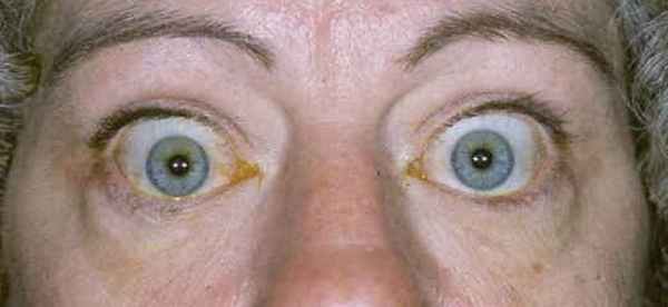 Эндокринная офтальмопатия