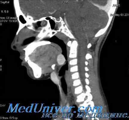 тиреотоксический криз