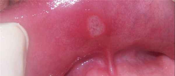 Стоматитная язвочка