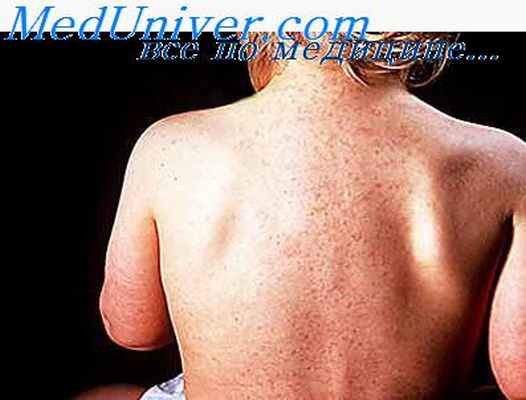 токсоплазмоз беременных