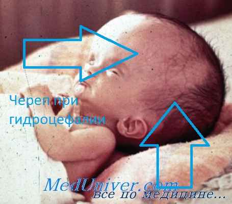 токсоплазмоз глаз