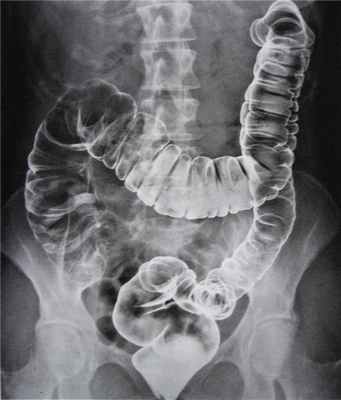 Ирригоскопия