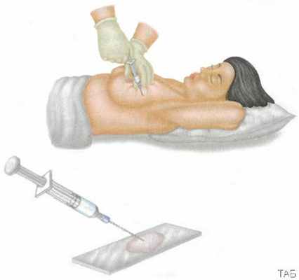 Биопсия молочной железы