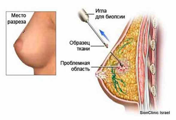 Как выполняется биопсия молочной железы