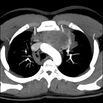 КТ средостения