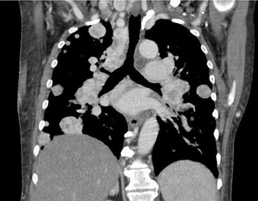 КТ средостения