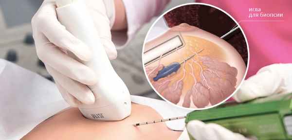 Как проводится биопсия молочной железы