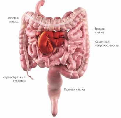 кишечная непроходимость схема