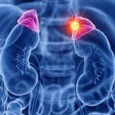 Рак надпочечников