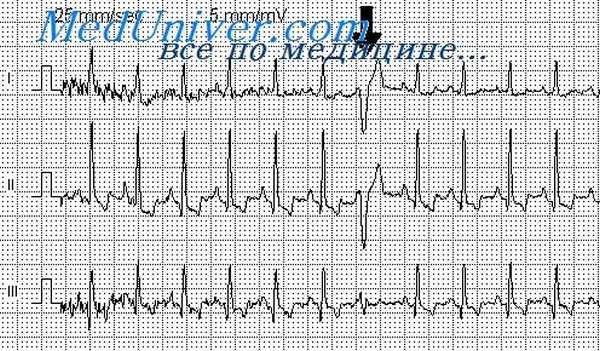экстрасистолия