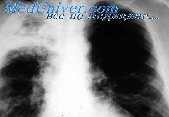 топография грудной стенки